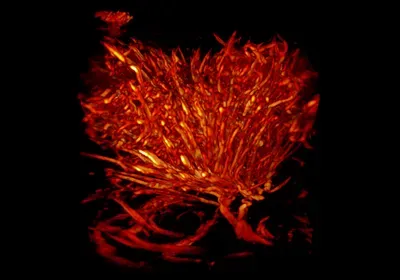 tumor brain surgery tumor brain surgery